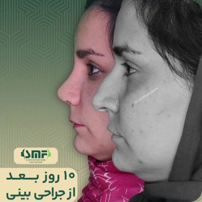 جراحی-بینی-39