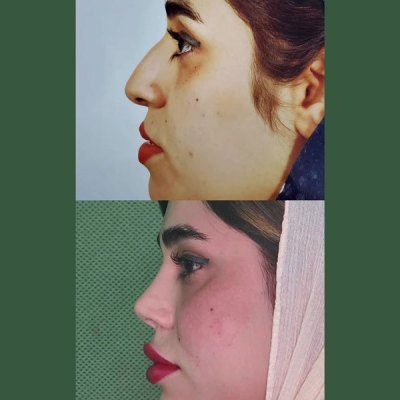 جراحی-بینی-47