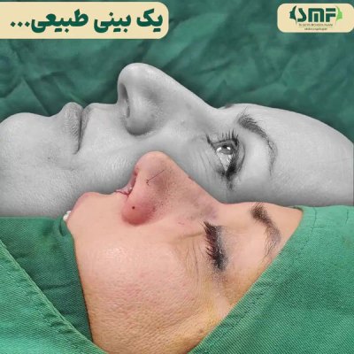 جراحی-بینی-50