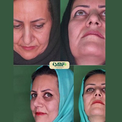 جراحی-بینی-51
