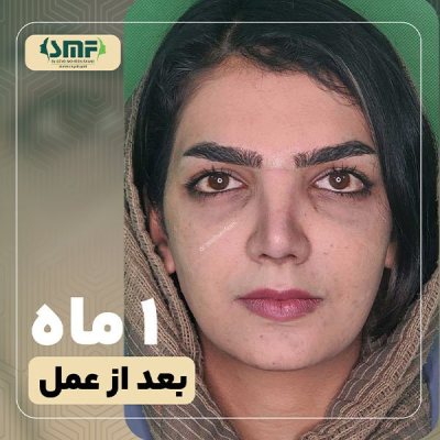جراحی-بینی-8