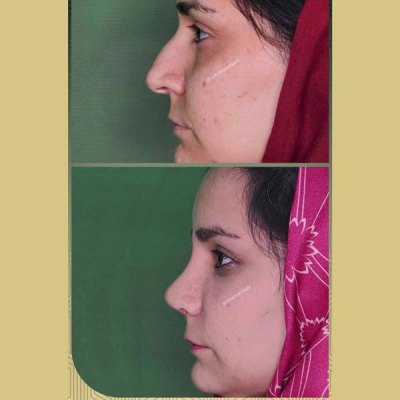 جراحی-بینی40