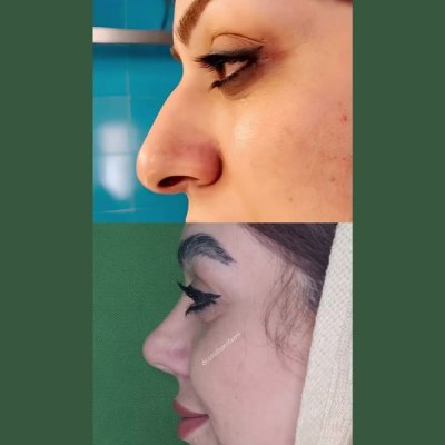 1_جراحی-بینی-38