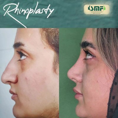 rhinoplastie-53