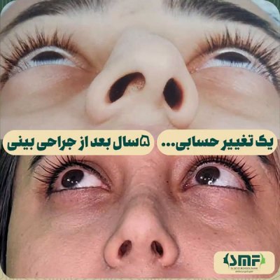rhinoplastie52
