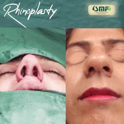 rhinoplastie54