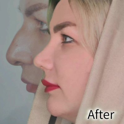 rhinoplastie55