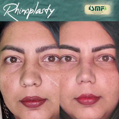 rhinoplastie56