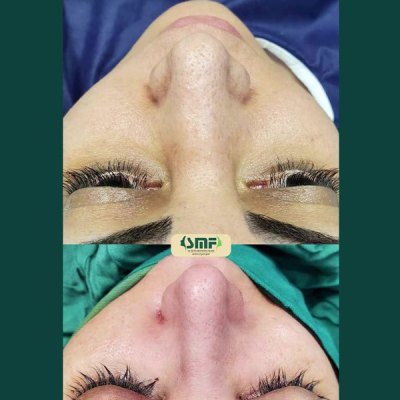 rhinoplastie57