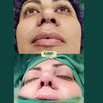 rhinoplastie58