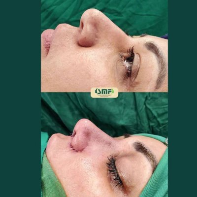 rhinoplastie59