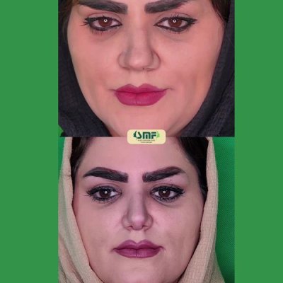 rhinoplastie82