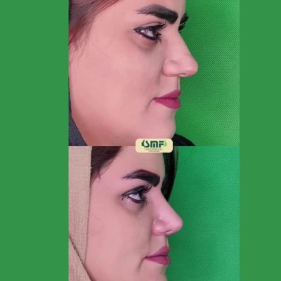 rhinoplastie83