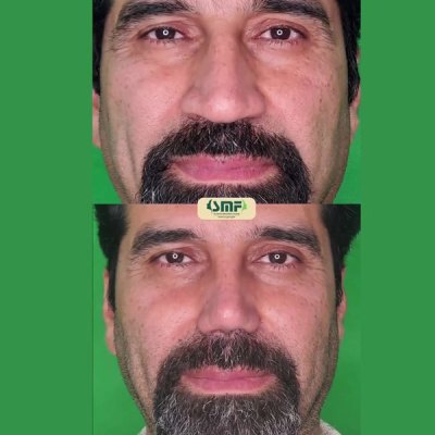 rhinoplastie84