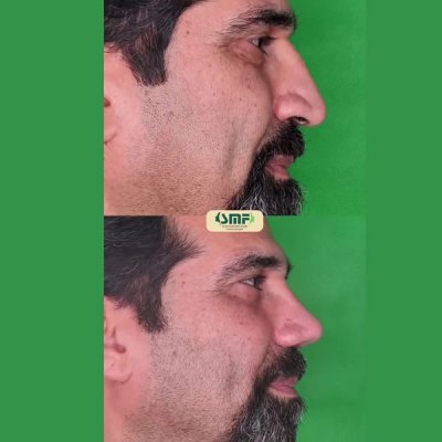 rhinoplastie85