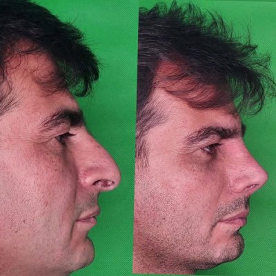 rhinoplastie86