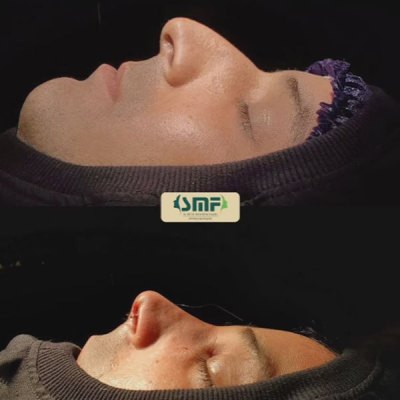 rhinoplasty-127