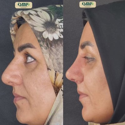 rhinoplasty-129