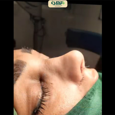 rhinoplasty-131
