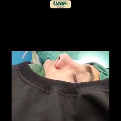 rhinoplasty-134