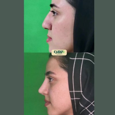 rhinoplasty101