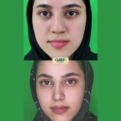 rhinoplasty102
