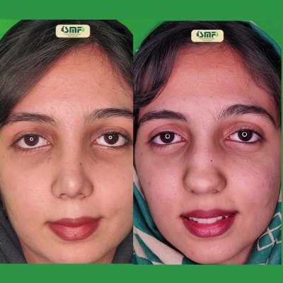 rhinoplasty103