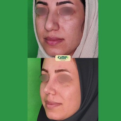 rhinoplasty104