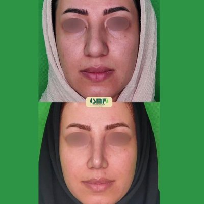 rhinoplasty105