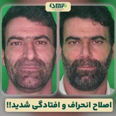 rhinoplasty106