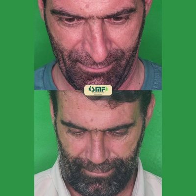 rhinoplasty107