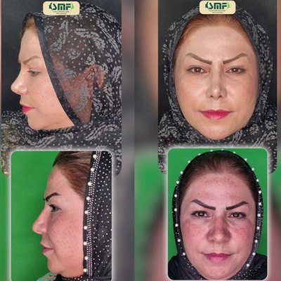 rhinoplasty111