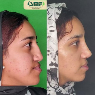 rhinoplasty112