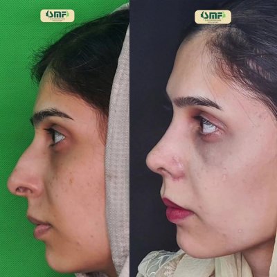 rhinoplasty113