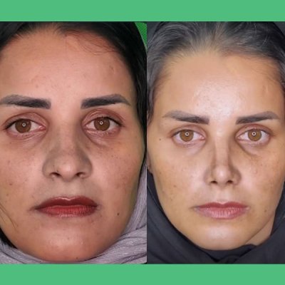 rhinoplasty114