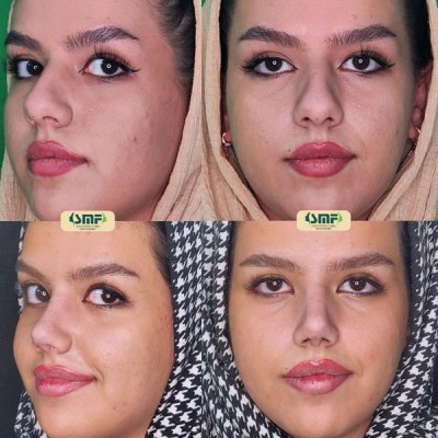 rhinoplasty115