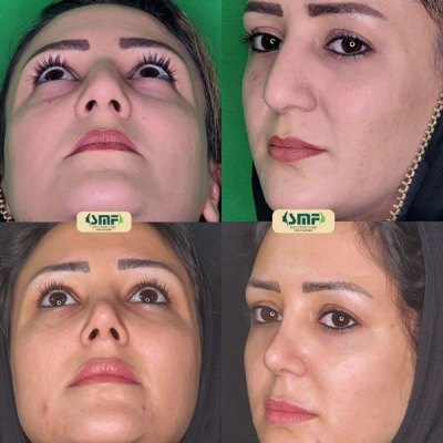 rhinoplasty116