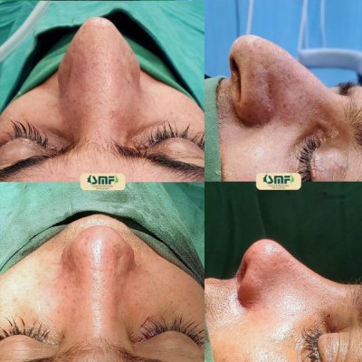 rhinoplasty117