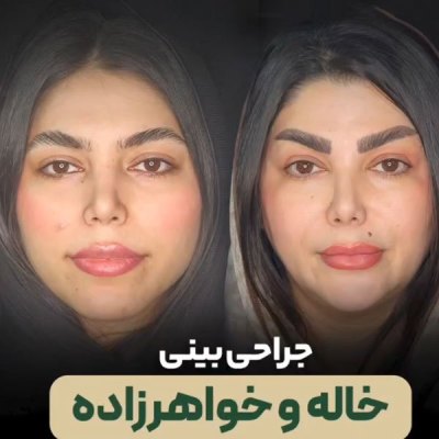 rhinoplasty118