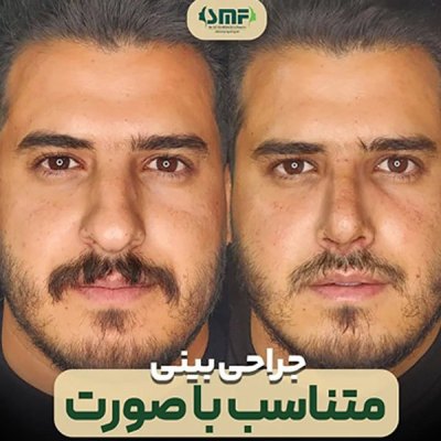 rhinoplasty119