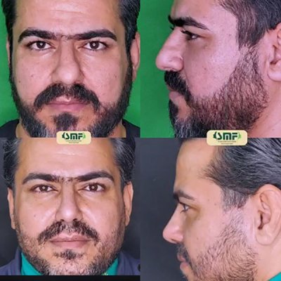 rhinoplasty121