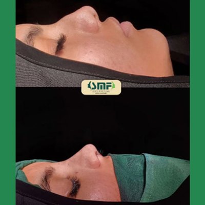 rhinoplasty122