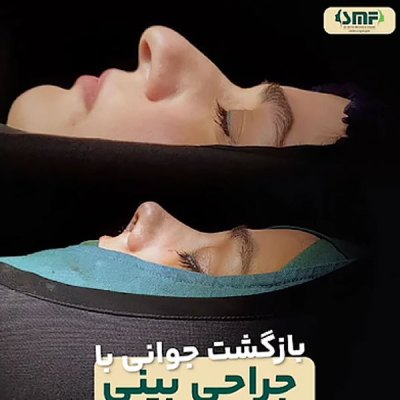 rhinoplasty124