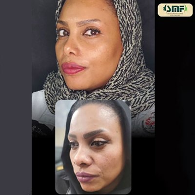 rhinoplasty125
