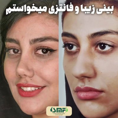 rhinoplasty60
