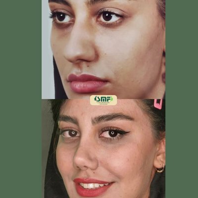 rhinoplasty61