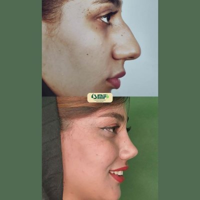 rhinoplasty62