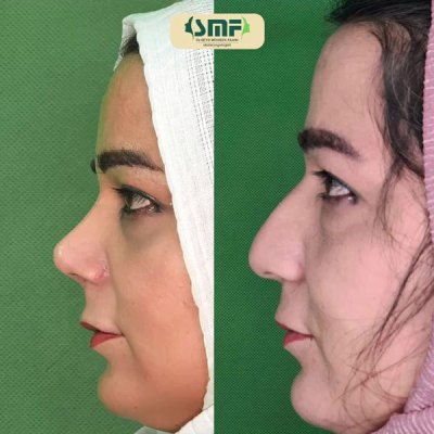 rhinoplasty63