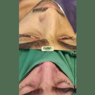 rhinoplasty64