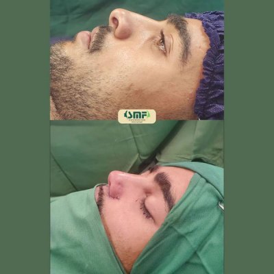 rhinoplasty65